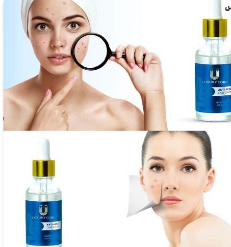 Biz Anti-Acne Serum